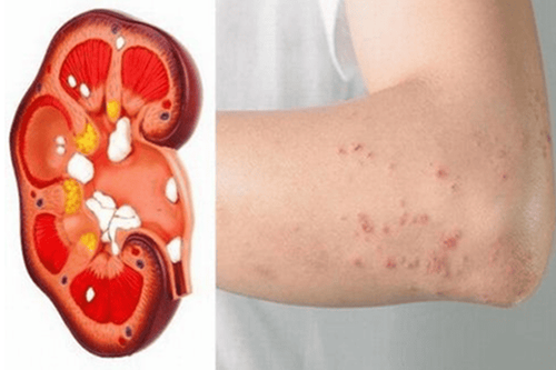 Dấu Hiệu Suy Thận - Những thay đổi dễ bị bỏ qua