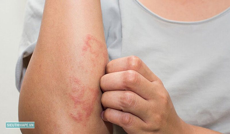 Kiến ba khoang cắn - Phân biệt với zona và herpes Kiến ba khoang cắn - Phân biệt với zona và herpes