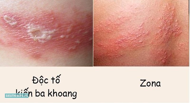Kiến ba khoang cắn - Những việc cần tránh Kiến ba khoang cắn - Những việc cần tránh