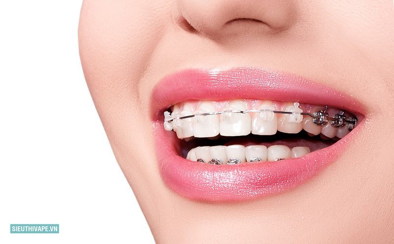 Niềng răng - Trường hợp thường được chỉ định Niềng răng - Trường hợp thường được chỉ định