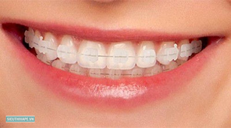 Niềng răng - Gắn mắc cài hoặc giao khay Niềng răng - Gắn mắc cài hoặc giao khay