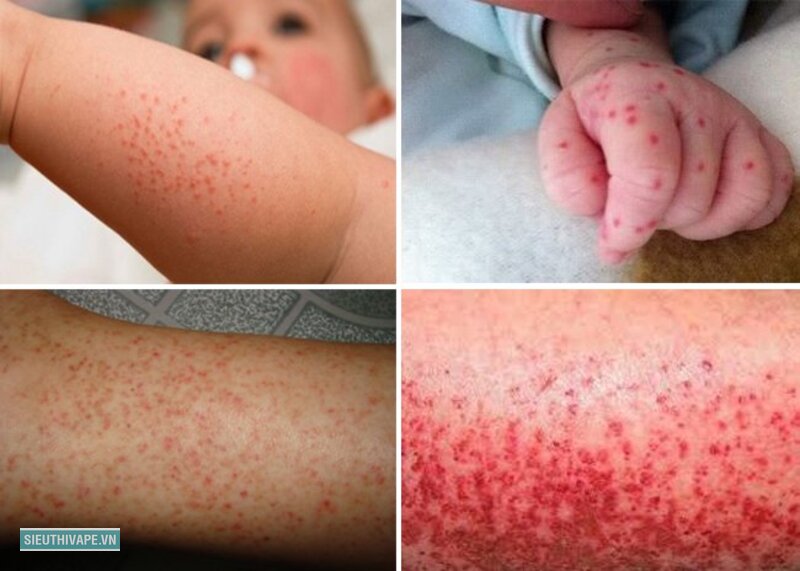 Triệu chứng sốt xuất huyết - Bệnh lây qua muỗi đốt chứ không lây trực tiếp giữa người với người Triệu chứng sốt xuất huyết - Bệnh lây qua muỗi đốt chứ không lây trực tiếp giữa người với người