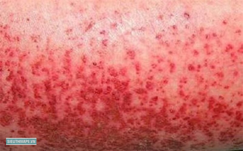 Triệu chứng sốt xuất huyết - Dấu hiệu cảnh báo phải đưa người bệnh tới cơ sở y tế ngay Triệu chứng sốt xuất huyết - Dấu hiệu cảnh báo phải đưa người bệnh tới cơ sở y tế ngay