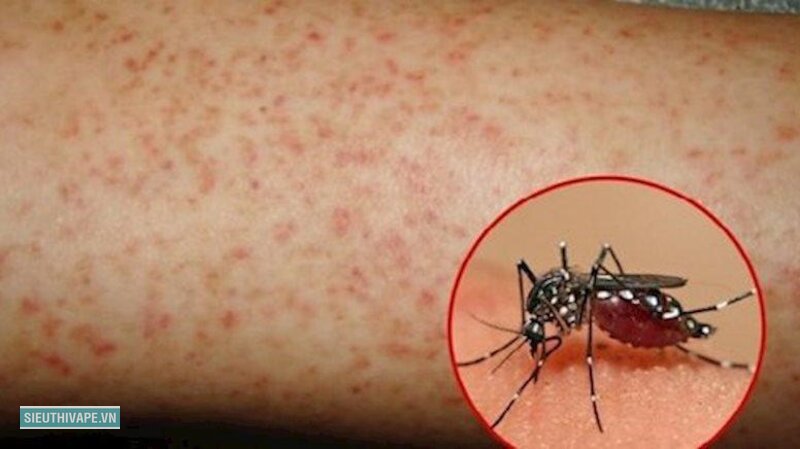 Triệu chứng sốt xuất huyết - Hạ sốt không có nghĩa là đã khỏi Triệu chứng sốt xuất huyết - Hạ sốt không có nghĩa là đã khỏi