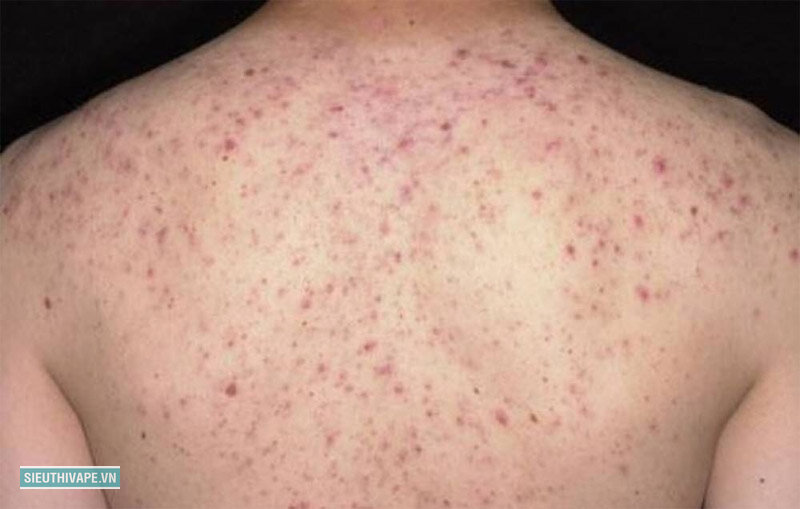 Viêm nang lông - Nang lông bị viêm trong hoàn cảnh nào Viêm nang lông - Nang lông bị viêm trong hoàn cảnh nào