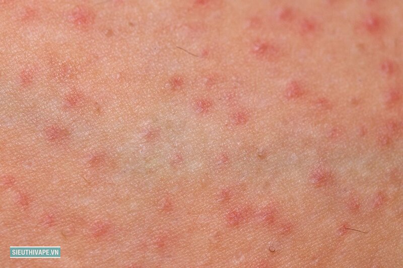 Viêm nang lông - Điều kiện sinh hoạt ở Việt Nam làm mọi thứ dễ xảy ra hơn Viêm nang lông - Điều kiện sinh hoạt ở Việt Nam làm mọi thứ dễ xảy ra hơn