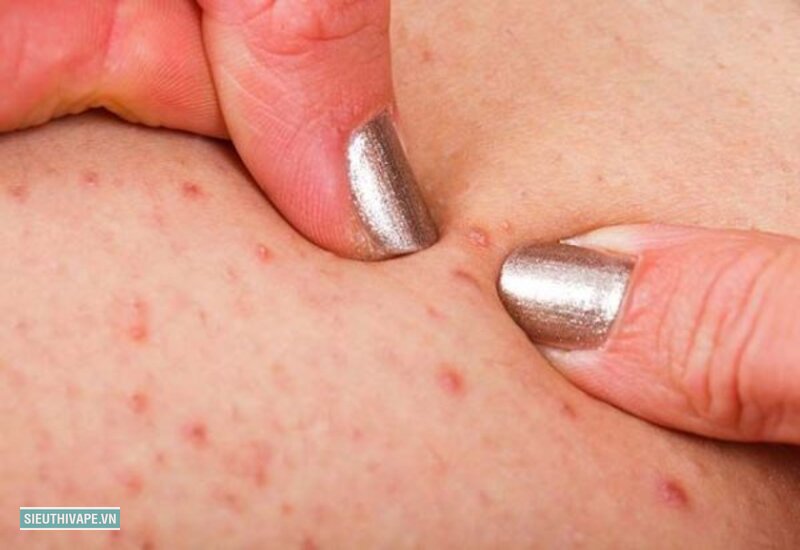 Viêm nang lông - Cạo ngược chiều và cạo lên vùng da khô Viêm nang lông - Cạo ngược chiều và cạo lên vùng da khô